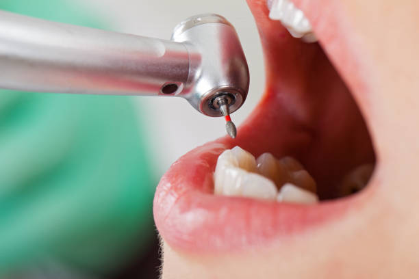 Best Urgent Care for Lost Fillings or Crowns in Harrison, NJ